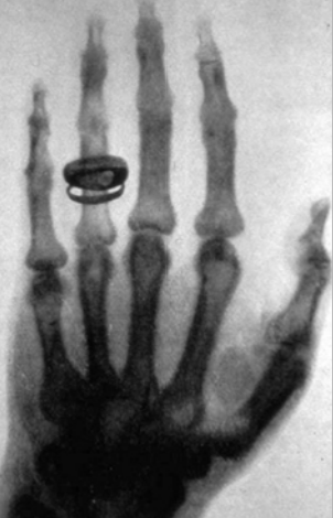 Röntgenbild einer Hand, knöcherne Strukturen sichtbar, mit einem Ring an einem Finger
